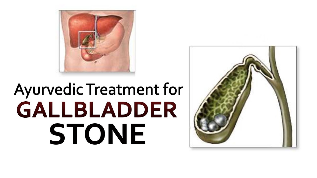 gallbladder-stone-ayurvedic-treatment